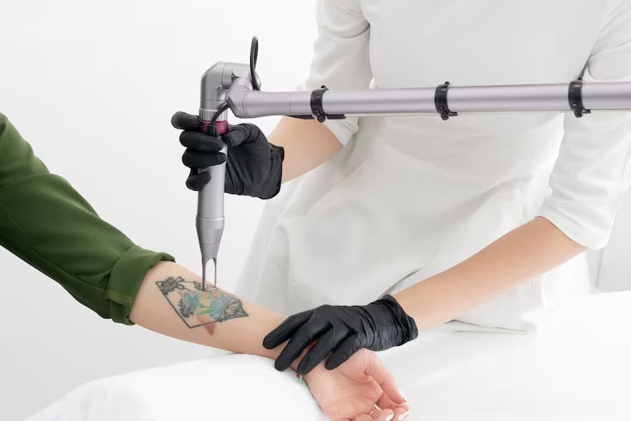 Tattoo Removal